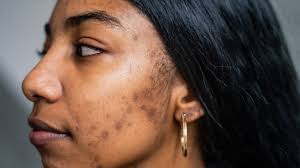 Dark spots are common. Here's what actually fades them.